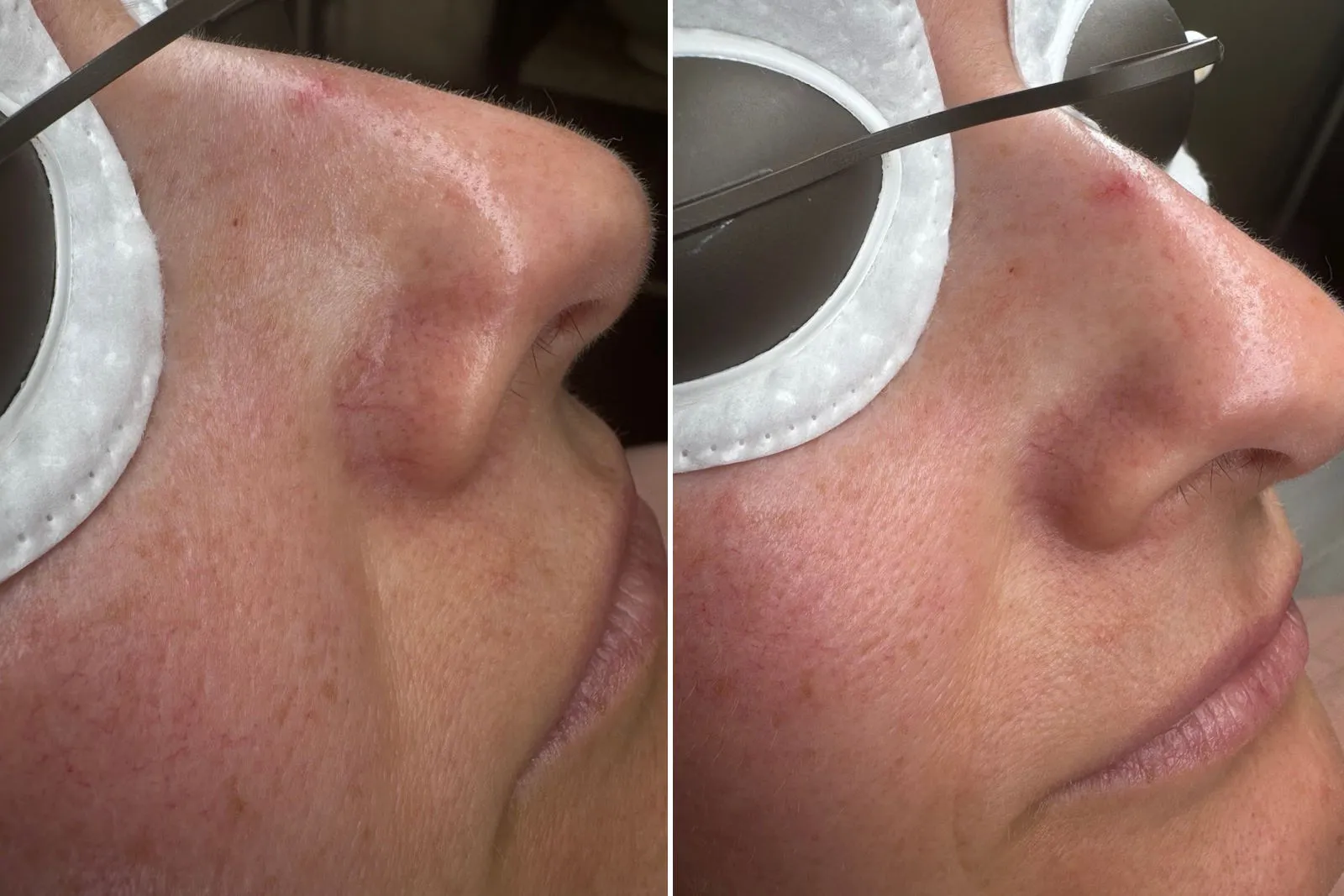 Best laser treatment for broken capillaries in McKinney, TX using PolyLase MX Nd:YAG 1064 nm laser on facial red vessels.