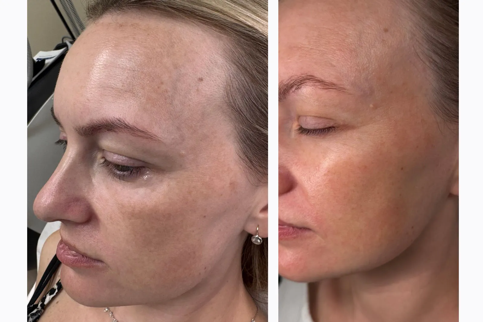 Before and after laser age spot removal in McKinney, TX showing clearer and even skin tone | Essence Laser