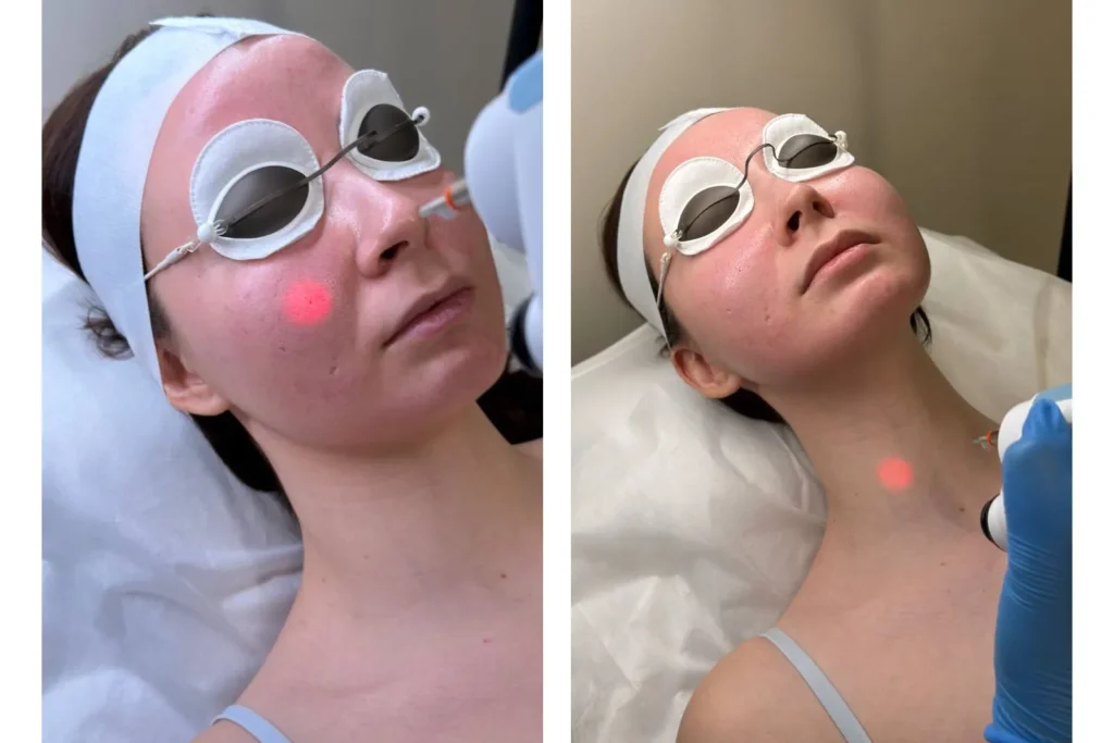 Laser Genesis treatment cost in McKinney, TX using PolyLase MX Nd:YAG 1064 nm laser for smooth skin.