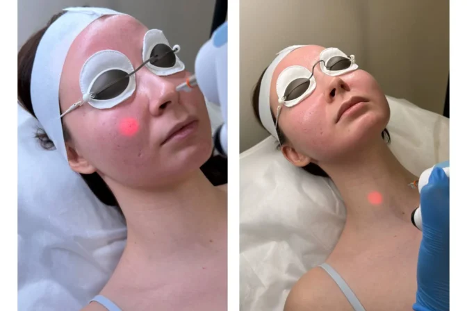Laser Genesis Treatment Cost in McKinney, TX | Pricing, Packages & Skin Rejuvenation