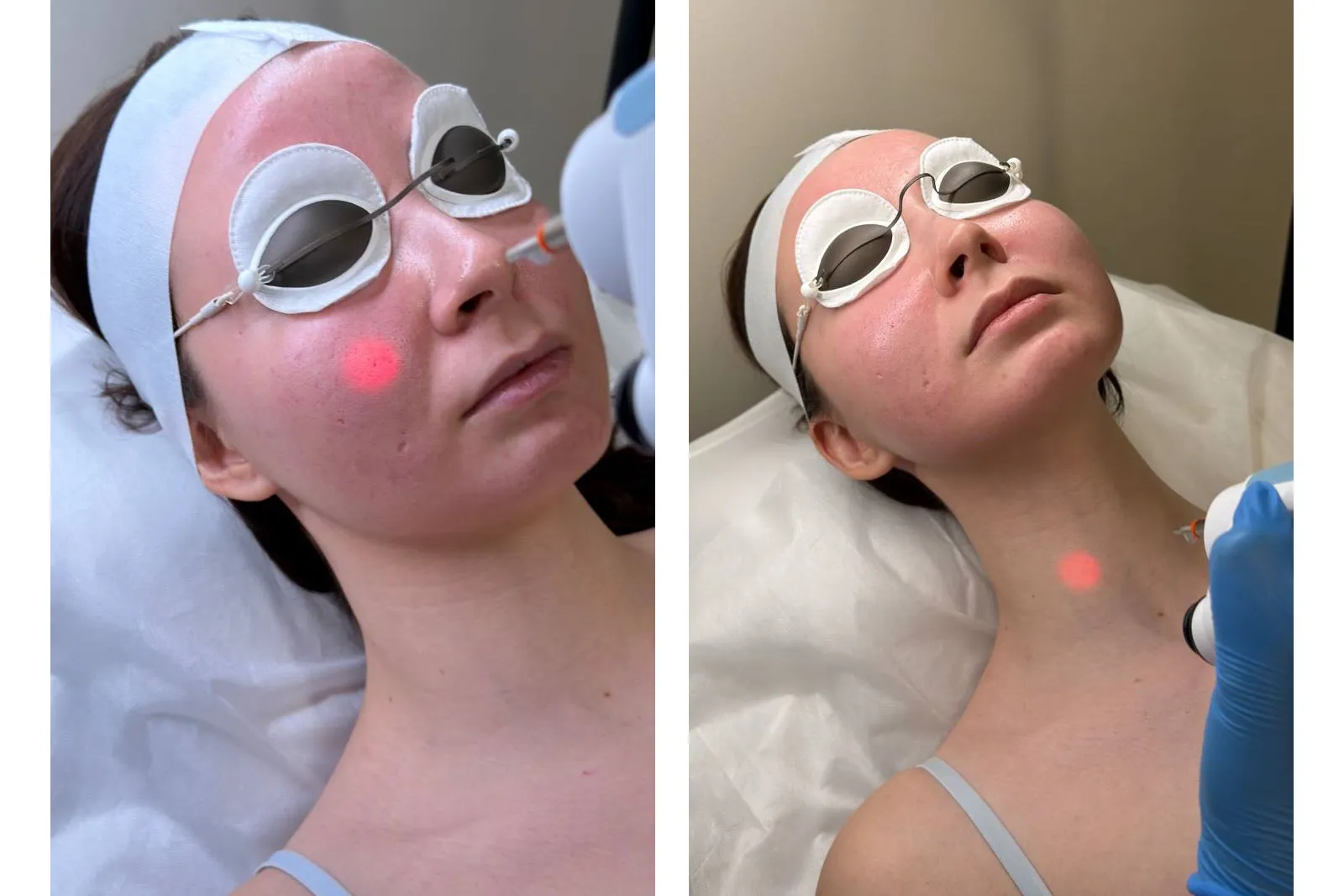 Laser Genesis Treatment Cost in McKinney, TX | Pricing, Packages & Skin Rejuvenation